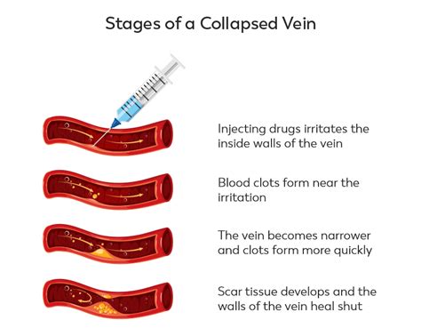 Is a blown vein dangerous.  This Conclusion Understanding what causes a...