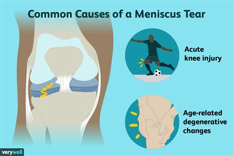 Is a meniscus tear causing your painful and clicking knee?