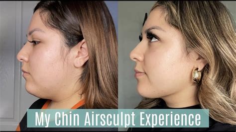 Is airsculpt worth it. Jan 1, 2021 · Based on Chin CoolSculpting current pricing of $1,400, we can estimate Chin Airsculpt average price at $1,400 – $2,500.The treatment usually lasts for 35 minutes. The physician might include the amount of fat that he will remove as a factor for pricing. It is logical to say that the more fat a patient has in her chin, the longer it takes for ... 