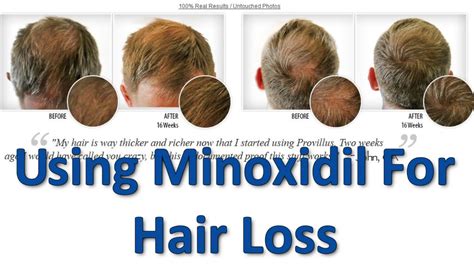 Is anyone using Minoxidil for hair loss? Mumsnet