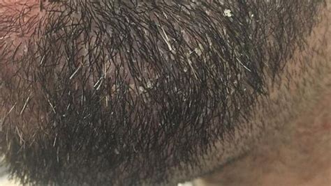 Is beard dandruff a fungus