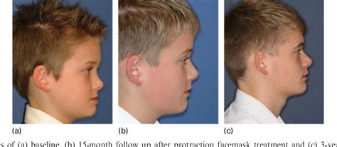 Is early class III protraction facemask treatment effective? A ...