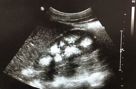 Is echogenic kidneys normal.  Mar 24, 2026 · An echogenic kidney is a kidney that ...