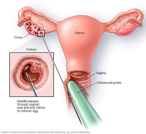 Is egg retrieval painful in ivf