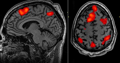 Is fmri invasive. A CT of the brain is typically used to evaluate the brain for tumors and other lesions, injuries, intracranial bleeding, hydrocephalus, stroke, vascular dementia, infection, inflammation and many other conditions. CT scans can also offer image-based guidance for brain surgery or biopsies of brain tissue. Figure 1: A CT scanner in use. 