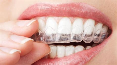 Is invisalign worth it. Things To Know About Is invisalign worth it. 
