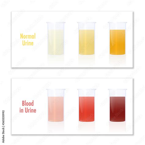 Is it normal to have a trace of blood in urine? – …