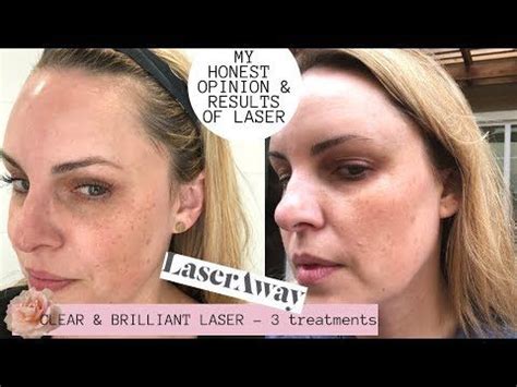 Is laseraway good. The good news is that Botox works for both. It’s most effective on wrinkles that haven’t quite set in yet, and can reduce the onset of wrinkles before they become moderate or severe. By combining Botox with a good skincare regimen, daily sunscreen and a healthy lifestyle, you can prevent most wrinkles from getting worse AND prevent new ones ... 