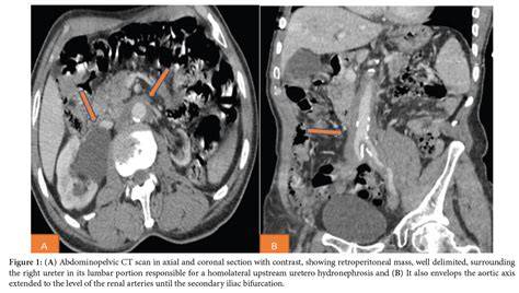 Is retroperitoneal fibrosis an autoimmune disease.  Left untreated, the dis...