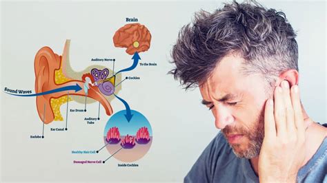 Is ringing in the ears commom with Phentermine and does it persist?