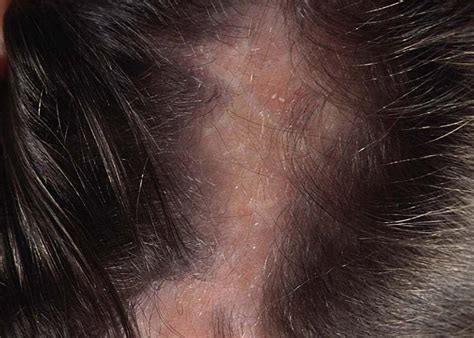 Is scalp bacterial infection contagious? - The Healthy Journal