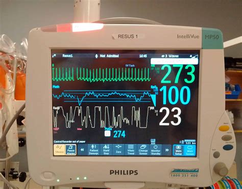 Is the mechanism of supraventricular tachycardia in pediatrics