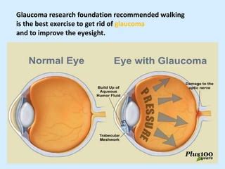 Is walking good for glaucoma