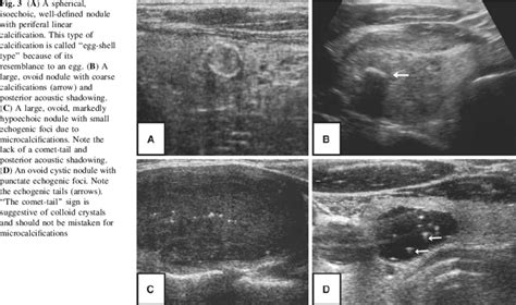 Isoechoic nodule meaning.  1D —Categories of echogenic foci.  Entire nodule has il...