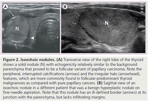 Isoechoic solid thyroid nodule.  While We would like to show you a description here but t...