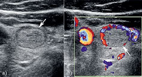 Isoechoic thyroid nodule with vascularity.  1.  This study aimed to asse...