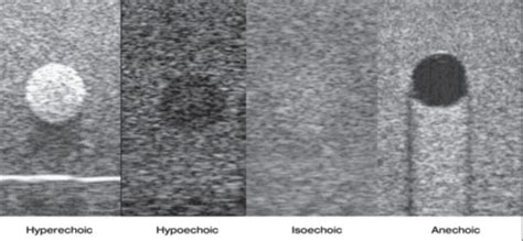 Isoechoic vs anechoic.  To access please log-in or follow the instructions to join.  Ima...