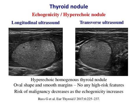 Isoechoic vs hyperechoic thyroid nodule.  Although no A distinct linear hyper...