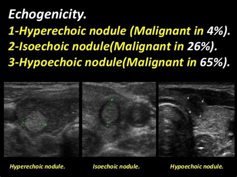 Isoechoic vs hypoechoic thyroid nodule.  AACE, AME, AND ETA GUIDELINES AACE, in co...