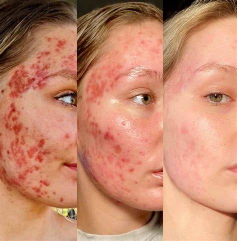 Isotretinoin biverkningar