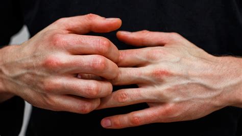 Itching Fingertips - I Am Getting Itch In My Fingers Tips At - Practo