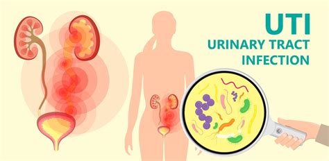 Itchy feeling in bladder