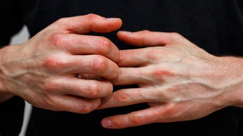 Atopic dermatitis, or eczema, can cause itchy, fine, red bumps on the fingers, hands, face, and other parts of the body. This condition affects around 15–20% of children and 1–3% of adults .... 