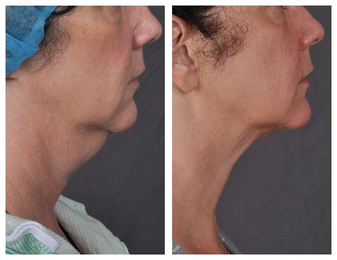 J plasma. J-Plasma is a new technology that promises dramatic skin tightening in only one session. During your J-Plasma procedure, a doctor will make small incisions, introduce a small cannula to remove the fat, then introduce a flow of ionized helium gas via a J-Plasma device directed to the subdermal tissue. 