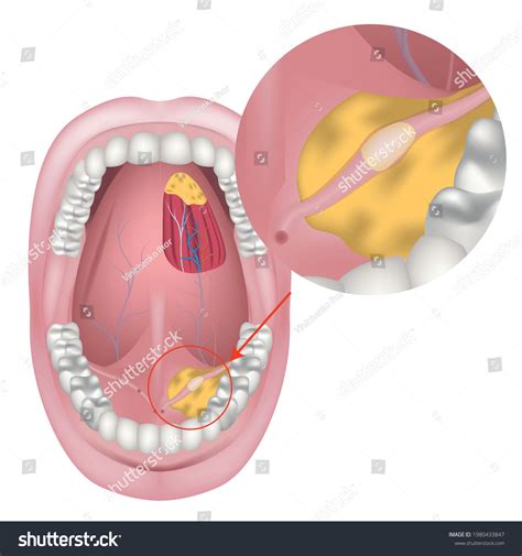 JCDR - Floor of the mouth, Infant, Salivary glands