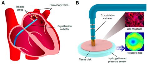 JKGD001 Ablation d