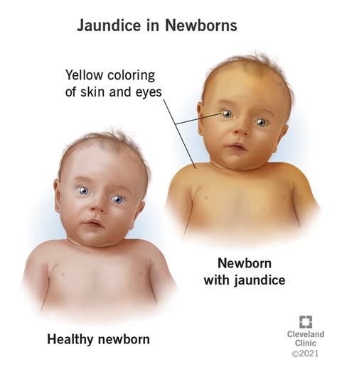 Jaundice in Newborns and Babies: Causes & Symptoms