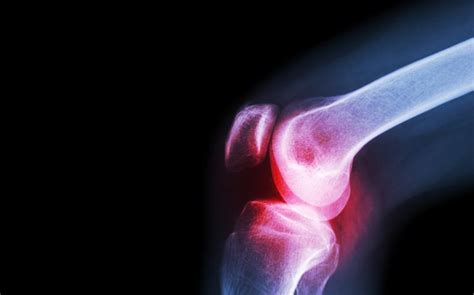 Joint lubricating fluid plays key role in osteoarthritic pain, study ...