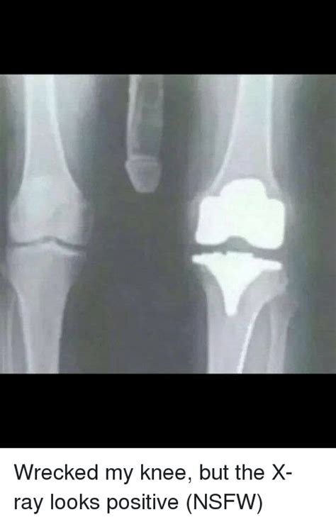 Joke x ray of knee. The knee x-ray joke is a great way to make people laugh and lighten up the mood. It is a simple yet effective way to get people in the right frame of mind for whatever situation they may be in. Though it may not be for everyone, it certainly gets the point across in a humorous way. 