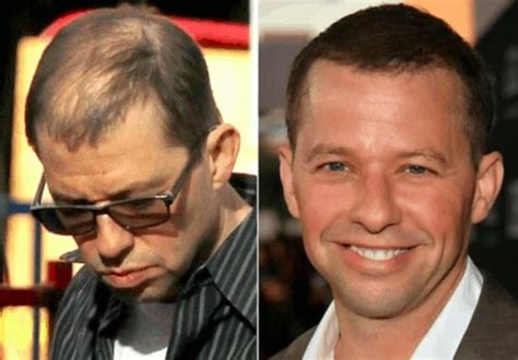 Jon cryer hair loss. Things To Know About Jon cryer hair loss. 