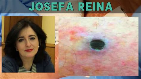 Josefa Reina – Best of the Best (Brand New) April 18, 2021 admin Medical. During the premier live chat someone mentioned that Enilsa Brown talked too much. Enilsa loves to teach her technique of using cotton tip applicators amongst other things like skin care. Why criticize anyone for what they do and how they do it.. 