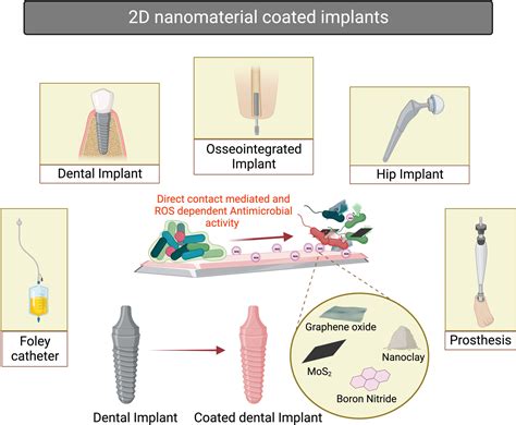 Journal of http//ddoiorg/112/ims11 Medical Implants and …