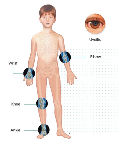 Juvenile Idiopathic Arthritis Riley Children