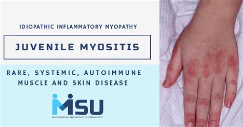 Juvenile Myositis - Myositis Support and Understanding