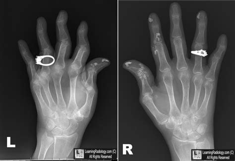 Köpeklerde Calcinosis Circumscripta.