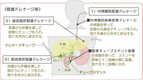 K682－2 経皮的胆管ドレナージ術 今日の臨床サポート - 最新の …