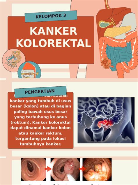KANKER KOLOREKTAL - Universitas Malikussaleh ACEH - muktibox.com