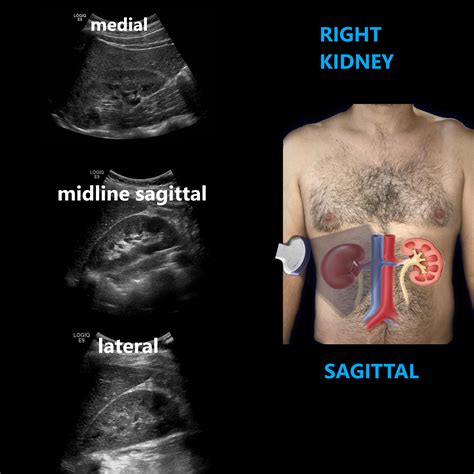 Kidney Ultrasound - Johns Hopkins Medicine - muktibox.com