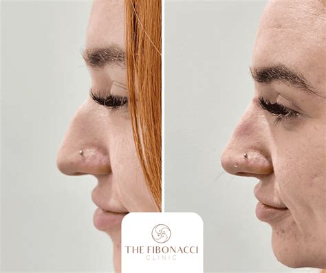 Korelasi Barisan Fibonacci dengan Rhinoplasty - wintechmobiles.com