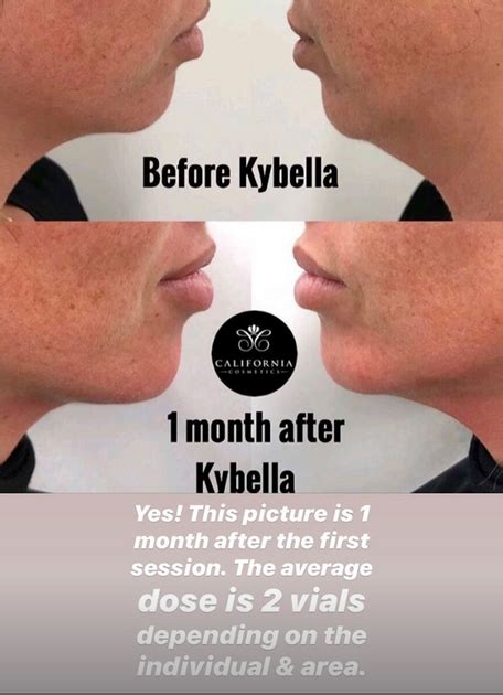 KYBELLA Double Chin Reduction Newport Beach Orange County CA