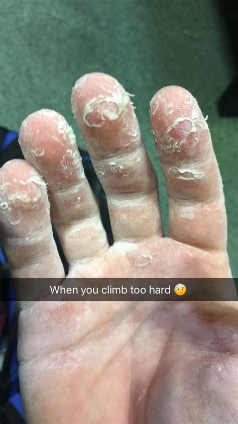 Keeping hands soft? : r/climbing - reddit