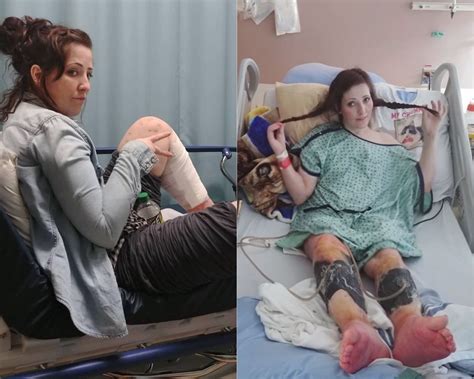 Kelly Ronahan is a woman who picked at scabs on her legs until bone 
