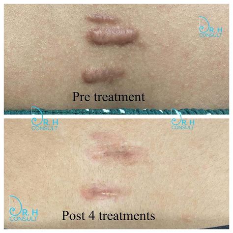 Keloid Scar Removal Acne Problem Help!
