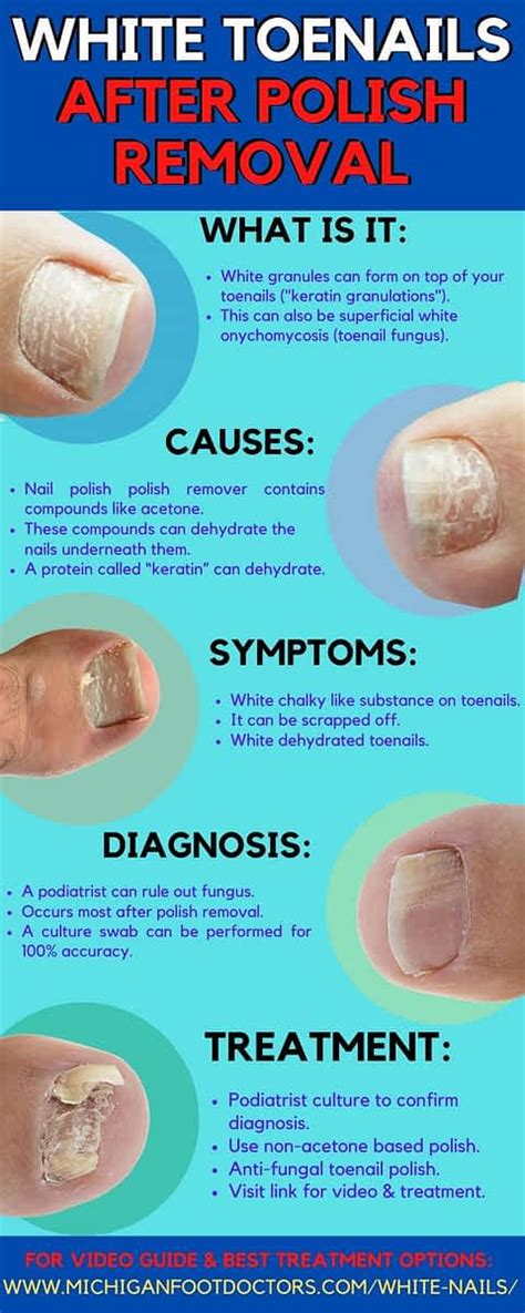 Keratin granulations vs fungus. Ciclopirox. Griseofulvin. Alternatives. Home remedies. Preventions. Consulting a doctor. Summary. Oral and topical antifungals are the two main treatment methods for nail fungus infection. Oral ... 