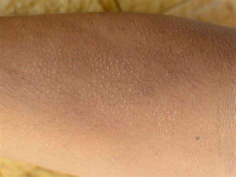 Keratosis Pilaris: What It Is & How To Treat It Naturally