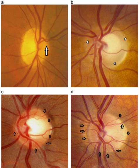 Kestenbaum Index - EyeWiki